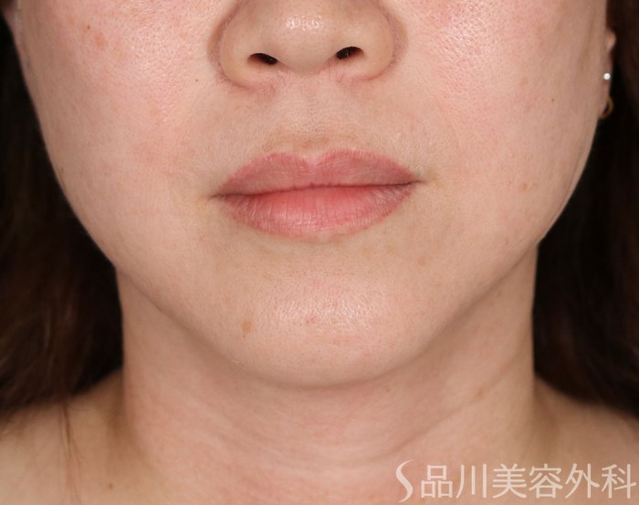 症例NO.73180のAFTER写真