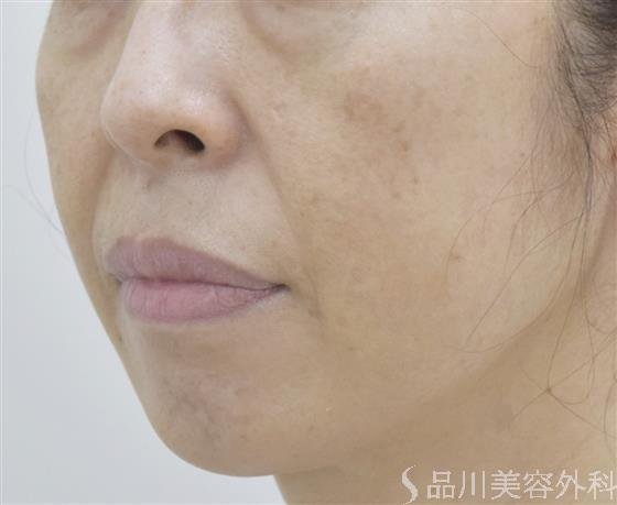 症例NO.53689のBEFORE写真