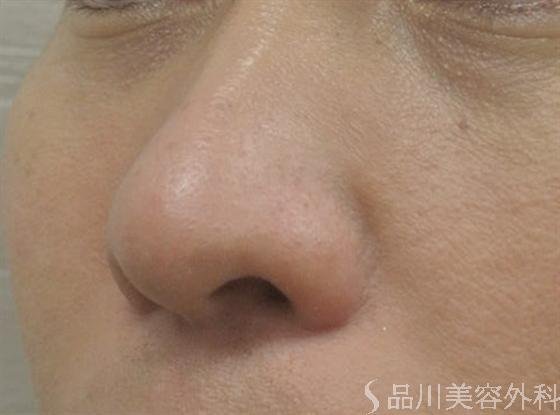 症例NO.15966のBEFORE写真