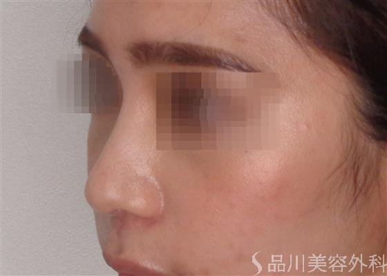 症例NO.47835のBEFORE写真