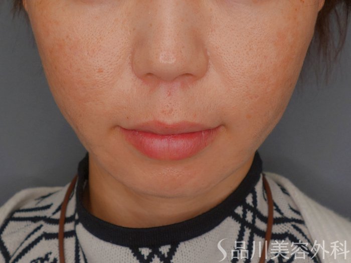 症例NO.73351のAFTER写真