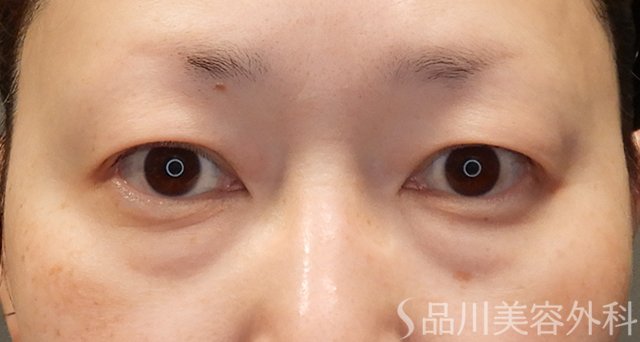 症例NO.74956のBEFORE写真