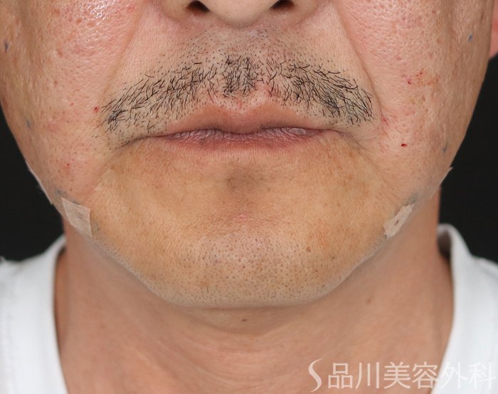 症例NO.71624のAFTER写真