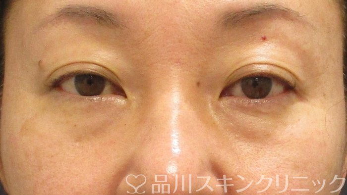 症例NO.69675のBEFORE写真
