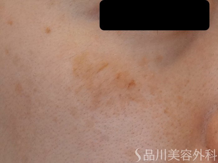 症例NO.70110のBEFORE写真