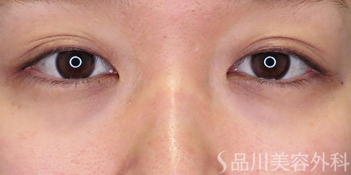 症例NO.71535のBEFORE写真