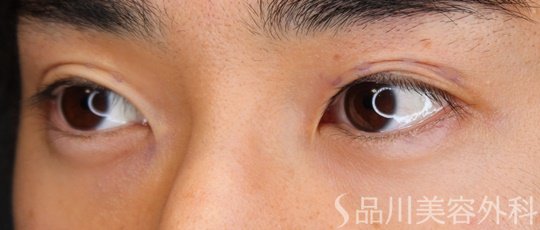 症例NO.65470のBEFORE写真