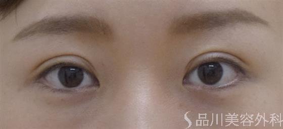症例NO.51782のAFTER写真