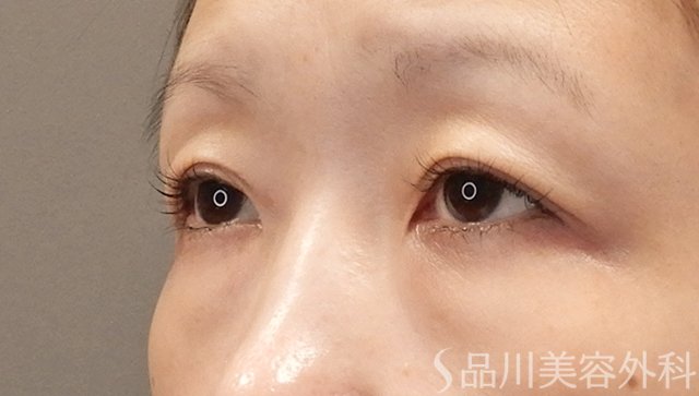 症例NO.75107のBEFORE写真