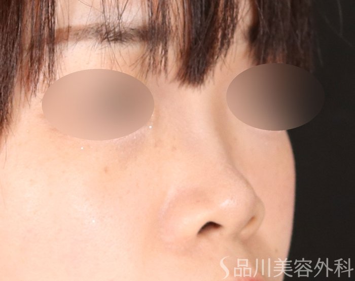 症例NO.71358のBEFORE写真