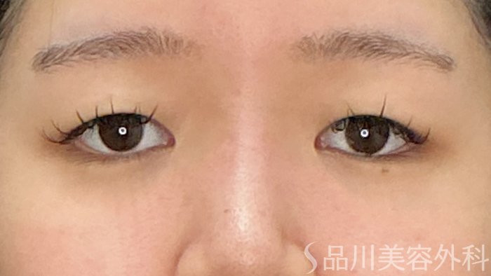 症例NO.71799のBEFORE写真