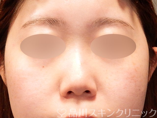 症例NO.69913のBEFORE写真