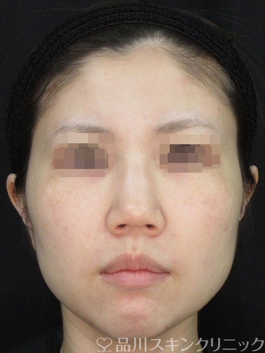 症例NO.72753のBEFORE写真