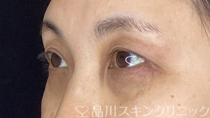 症例NO.70873のBEFORE写真