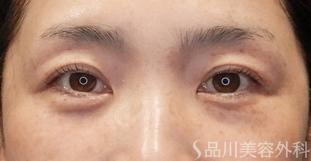 症例NO.74745のAFTER写真