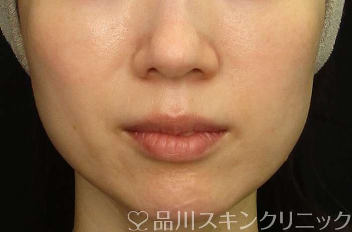症例NO.70201のBEFORE写真