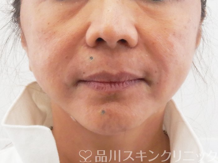 症例NO.63732のAFTER写真