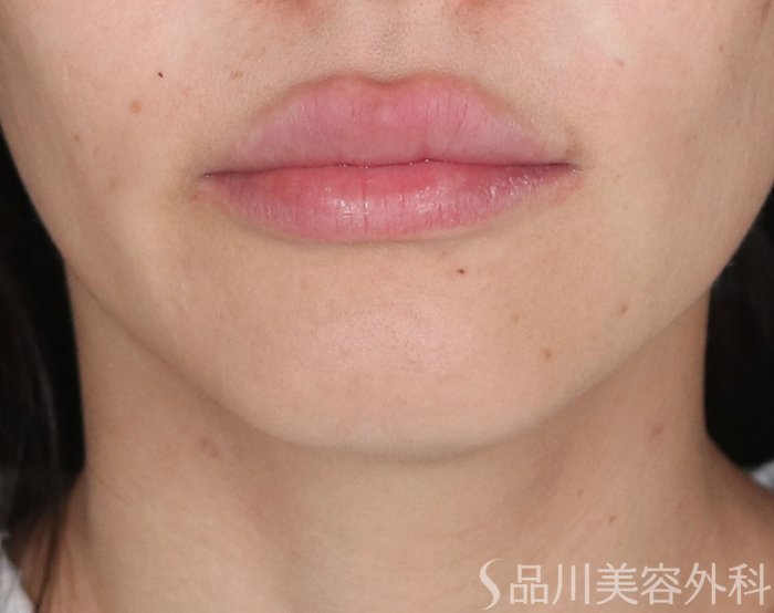 症例NO.72452のAFTER写真