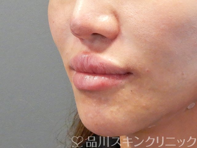 症例NO.71241のAFTER写真