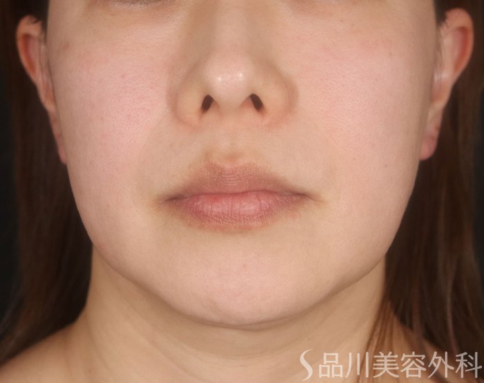 症例NO.73868のBEFORE写真