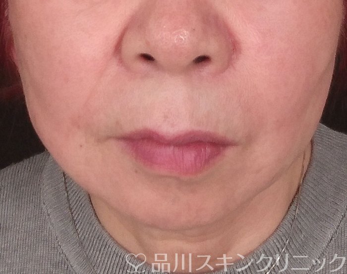 症例NO.69742のAFTER写真