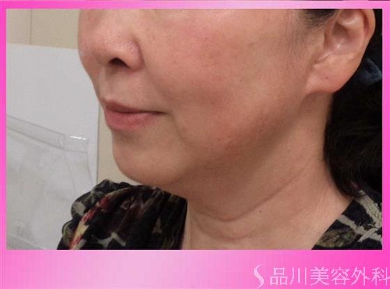症例NO.42475のBEFORE写真