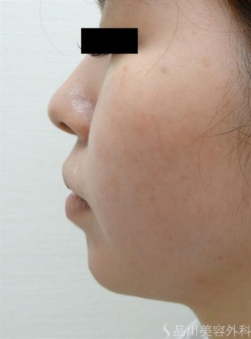 症例NO.42092のBEFORE写真