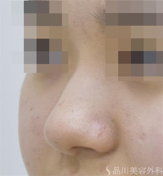 症例NO.47154のBEFORE写真