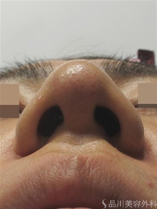 症例NO.43704のAFTER写真