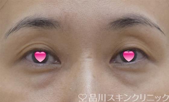 症例NO.60106のBEFORE写真