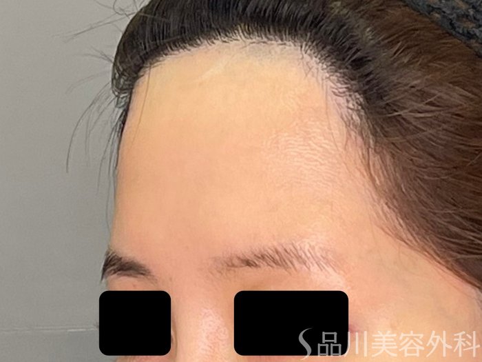 症例NO.71101のBEFORE写真