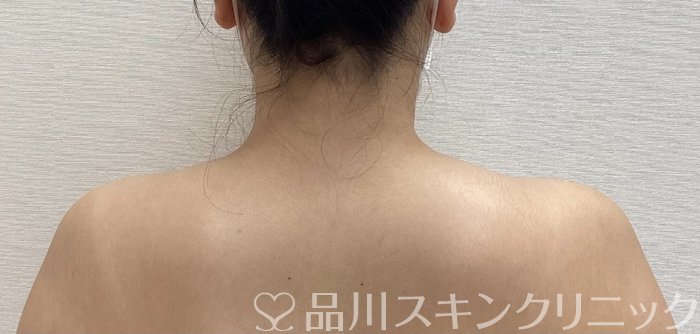 症例NO.69975のBEFORE写真