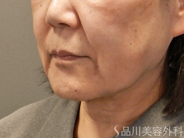 症例NO.72299のBEFORE写真