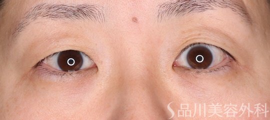症例NO.73949のBEFORE写真