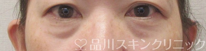 症例NO.71297のBEFORE写真