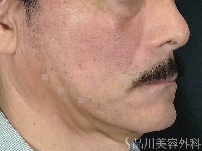 症例NO.70697のAFTER写真