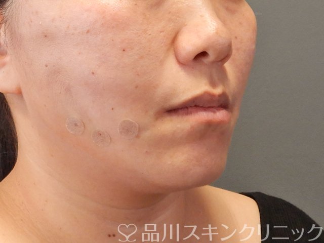 症例NO.75062のAFTER写真