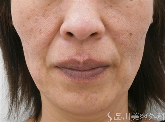 症例NO.27129のBEFORE写真