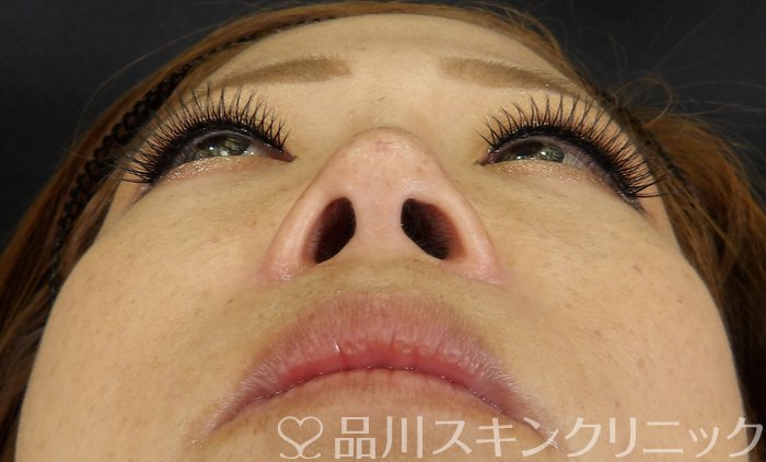 症例NO.67352のAFTER写真