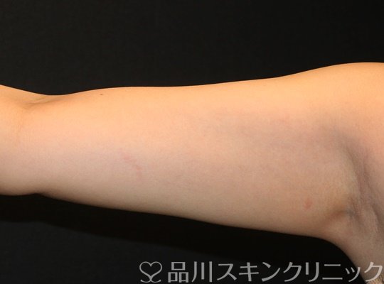 症例NO.70099のAFTER写真