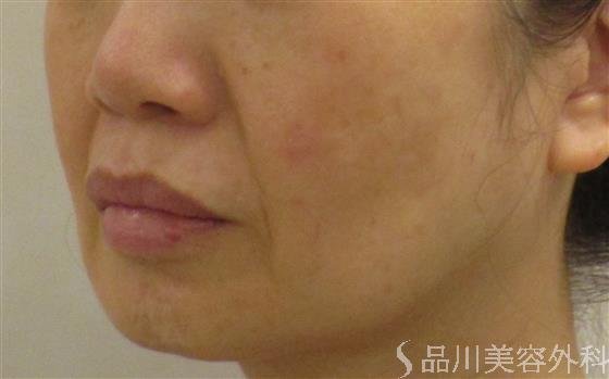 症例NO.58959のBEFORE写真