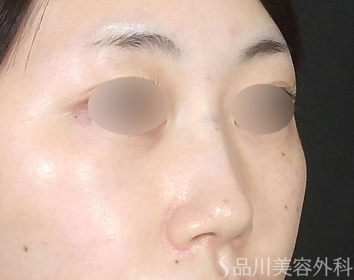 症例NO.70635のAFTER写真