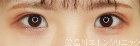 症例NO.54659のAFTER写真