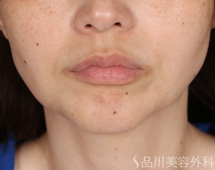 症例NO.74014のBEFORE写真