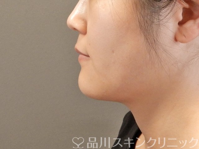 症例NO.65671のAFTER写真