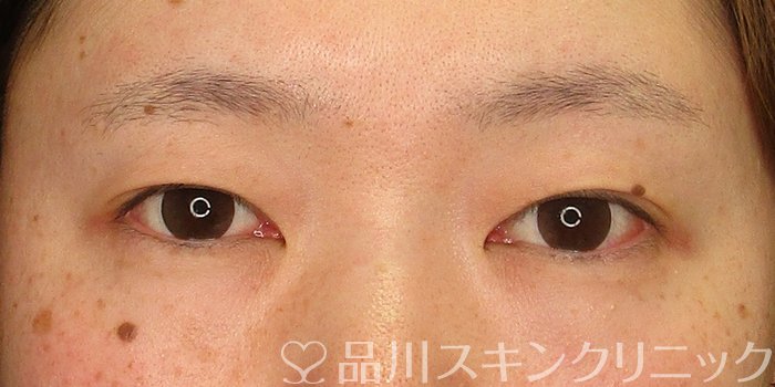 症例NO.69885のBEFORE写真