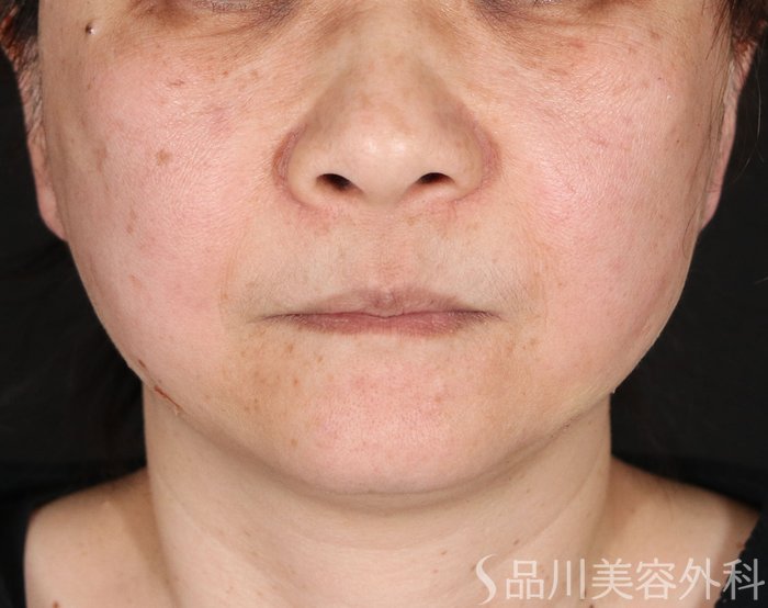 症例NO.72906のAFTER写真