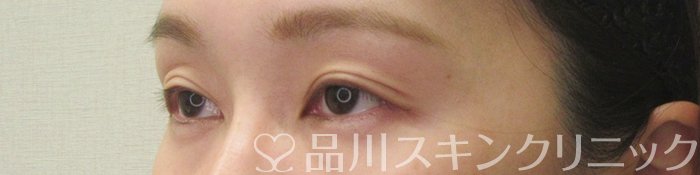 症例NO.75160のAFTER写真