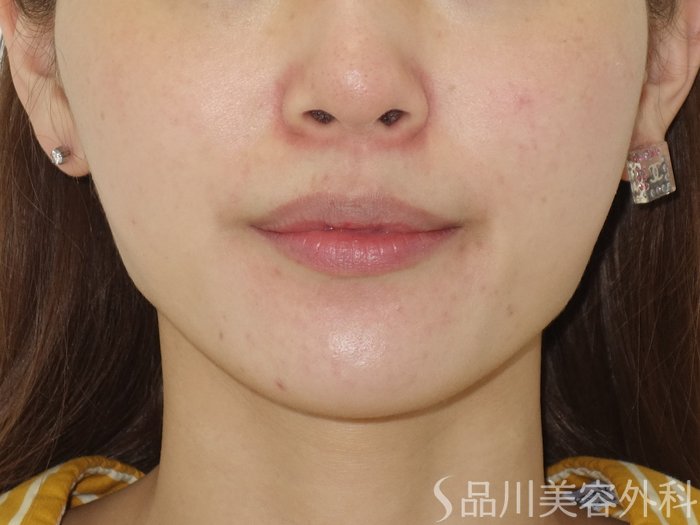 症例NO.69514のBEFORE写真