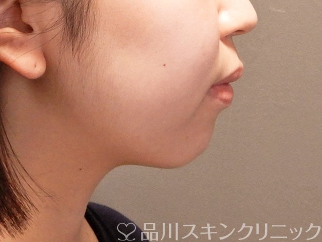 症例NO.70992のBEFORE写真